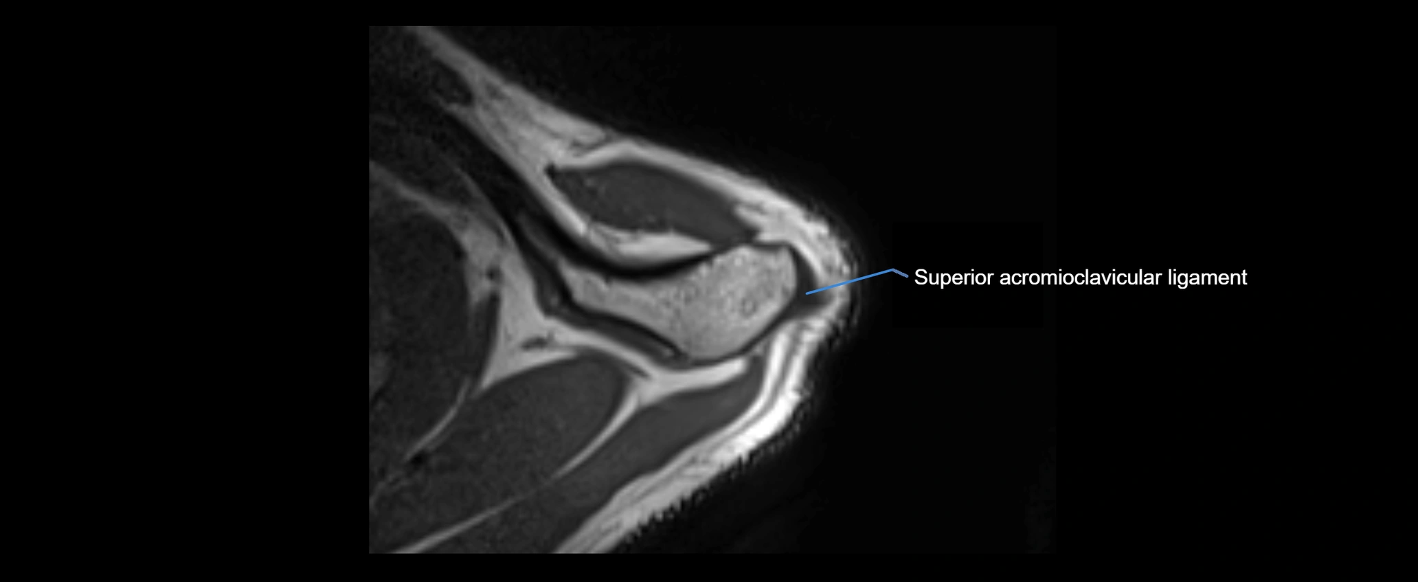 shoulder ligaments axial 3d 3t mri image-img-00005-00018.webp